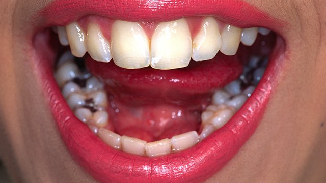 Plombage dentaire au Maroc : combien ça coûte et qu'est-ce qui détermine le  prix ?