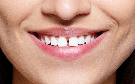 Traitement de diastèmes ou dents écartées par la technique des