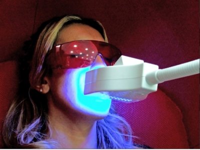Blanchiment dents par laser : sont les avantages ?